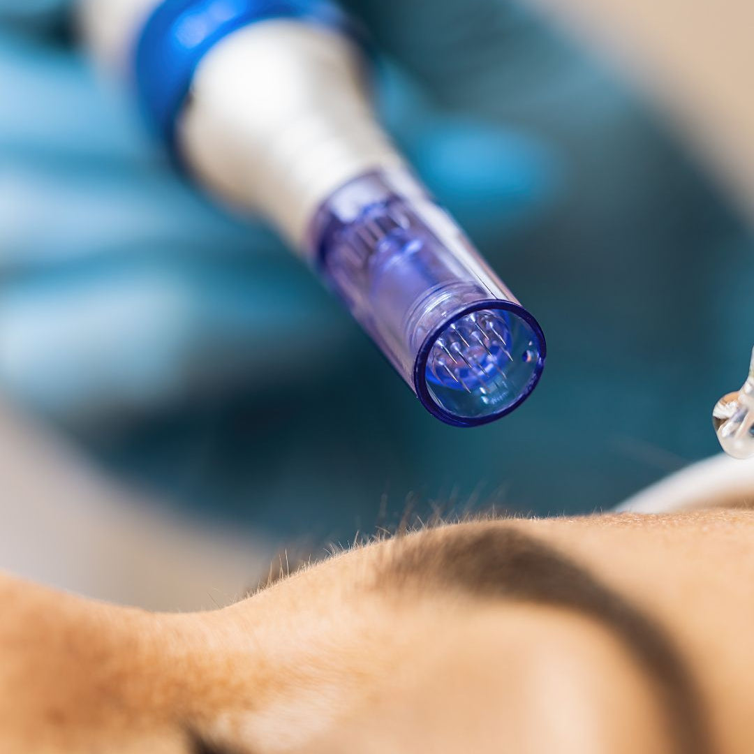 Atenuación de ojeras — microneedling y radiofrecuencia