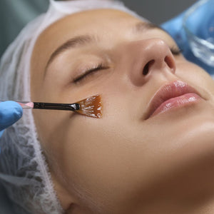 Peeling Químico