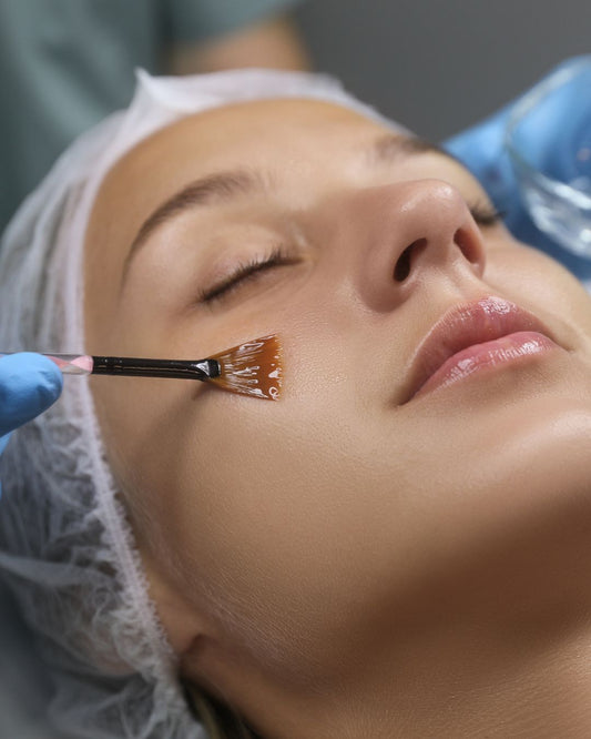 PEELING QUÍMICO